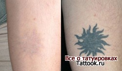 Гелевая тату не выводиться